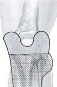 Férula tibial y pernea