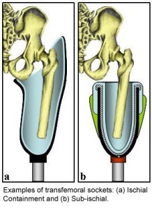 sub ischial 1